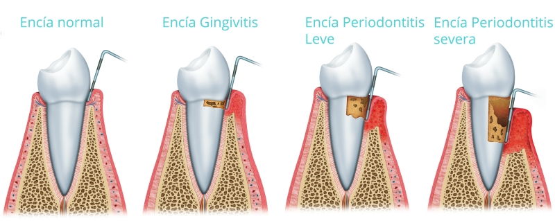 Periodoncistas en Margarita - Periodoncia en Venezuela - KOi Periodoncistas en Margarita - Periodoncia en Venezuela - KOi