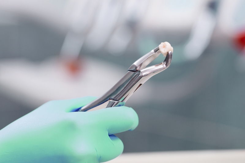 Cirguía dental profesional - Extracción muelas del juicio en Margarita Cirguía dental profesional - Extracción muelas del juicio en Margarita