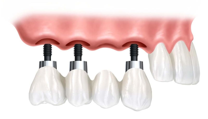 Periodoncia en Margarita - Implantes Dentales en Venezuela - KOi Dental Periodoncia en Margarita - Implantes Dentales en Venezuela - KOi Dental