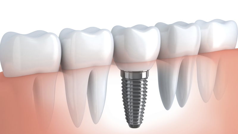 Implantes dentales en Margarita - Implantología de prótesis dentales Implantes dentales en Margarita - Implantología de prótesis dentales