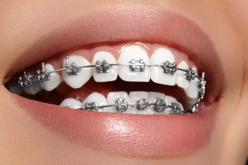 Ortodoncia en Margarita - Ortodoncistas en Venezuela - KOi Dental