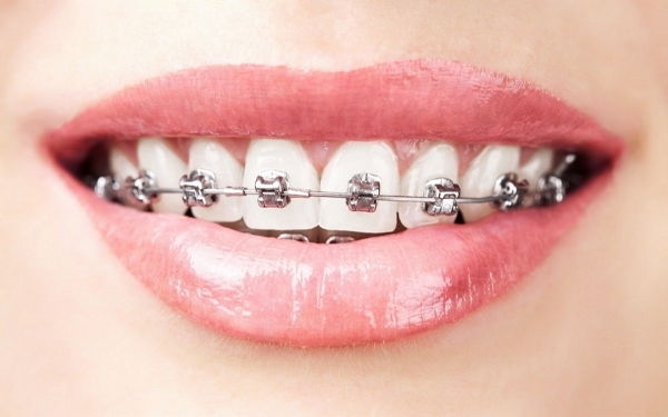 Servicio de Ortodoncia en Margarita - KOi Dental