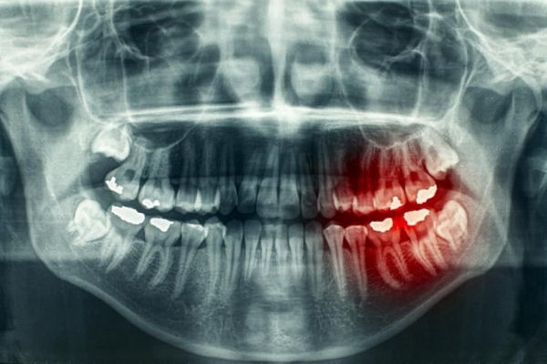 Servicio de Periodoncia en Margarita - KOi Dental